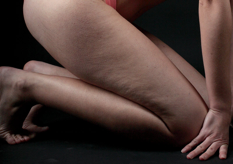 Lutte contre la cellulite en Gironde : quelques conseils pour la limiter
